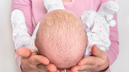 Croûtes de lait du bébé : comment en venir à bout ?