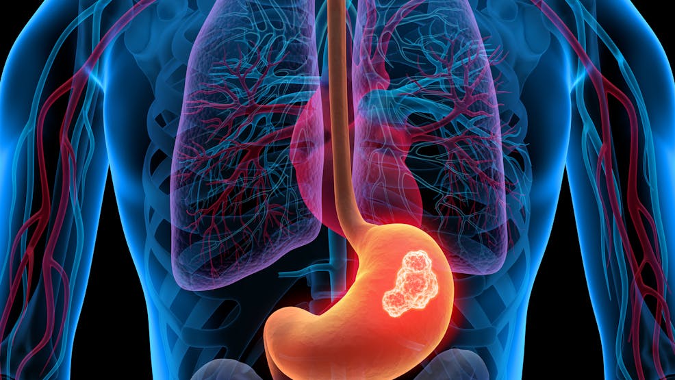 Cancer de l'estomac, cancer gastrique : causes, prévention, symptômes, traitements | Santé Magazine