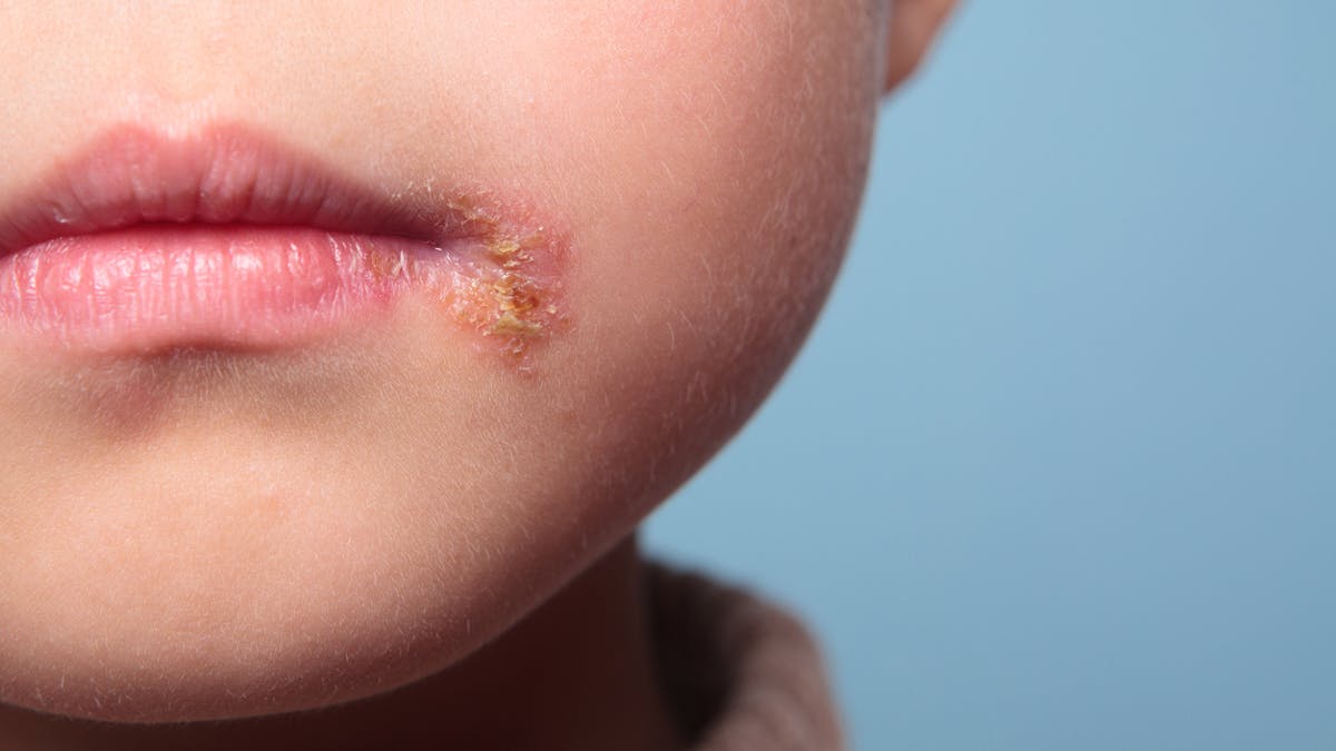 Herpes Chez Bebe Et L Enfant S Inquieter Ou Non Sante Magazine Herpes Chez Bebe Et L Enfant S Inquieter Ou Non Sante Magazine