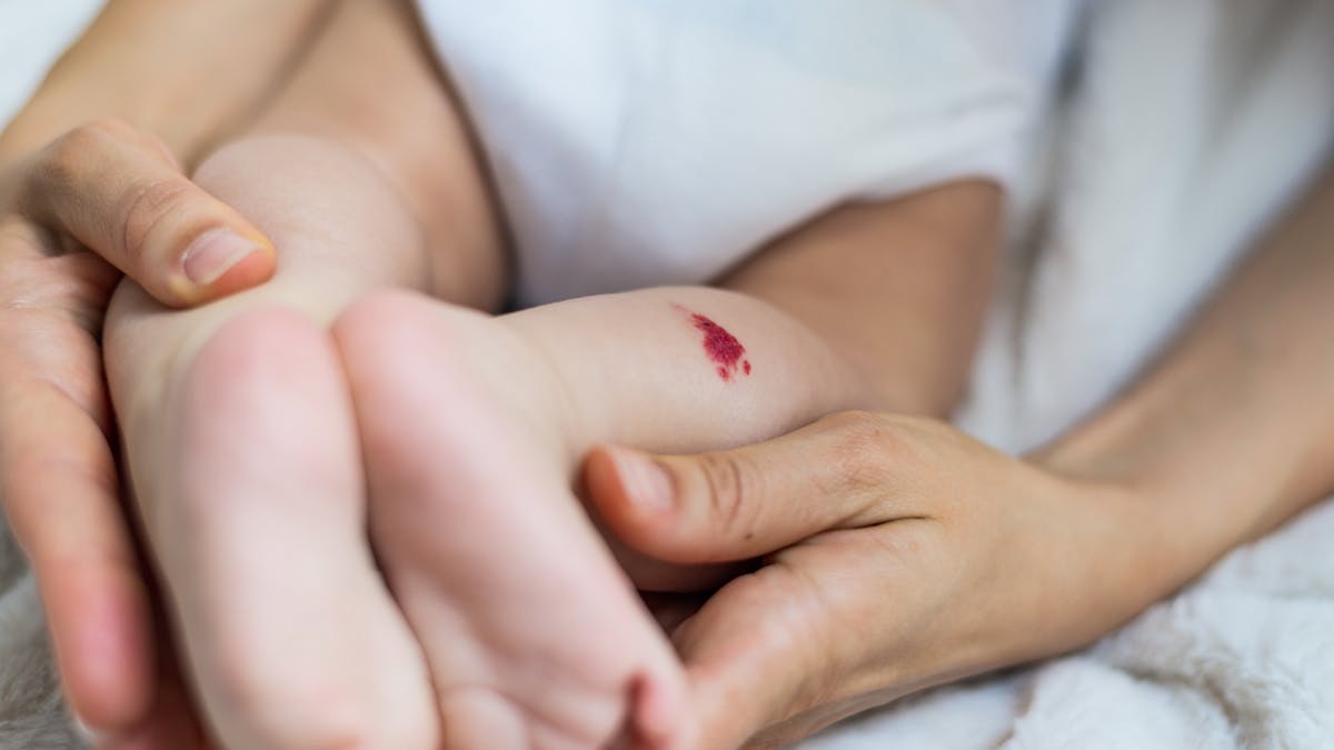 Angiome ou hémangiome sur la peau de bébé
