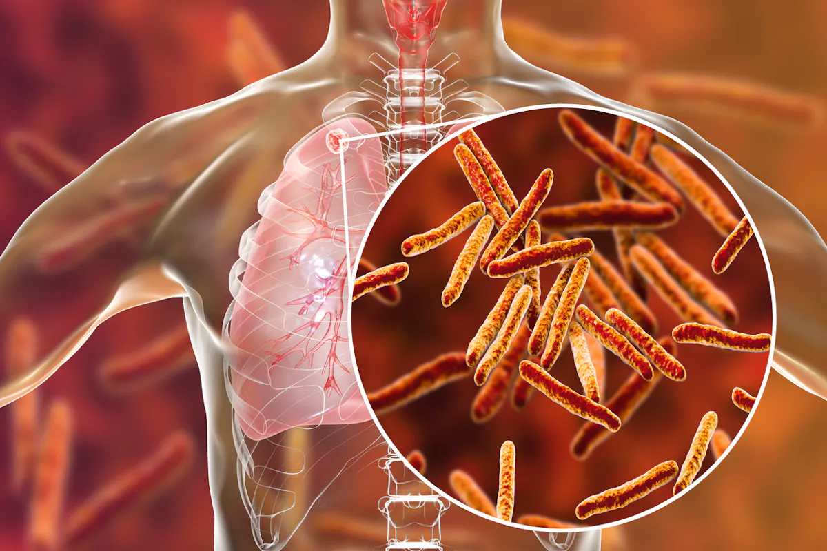 Tuberculose : comment la dépister et la traiter ? | Santé Magazine