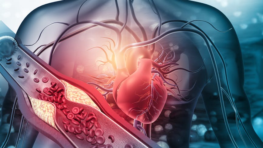 Coeur avec artères bocuhées, illustration artériosclérose