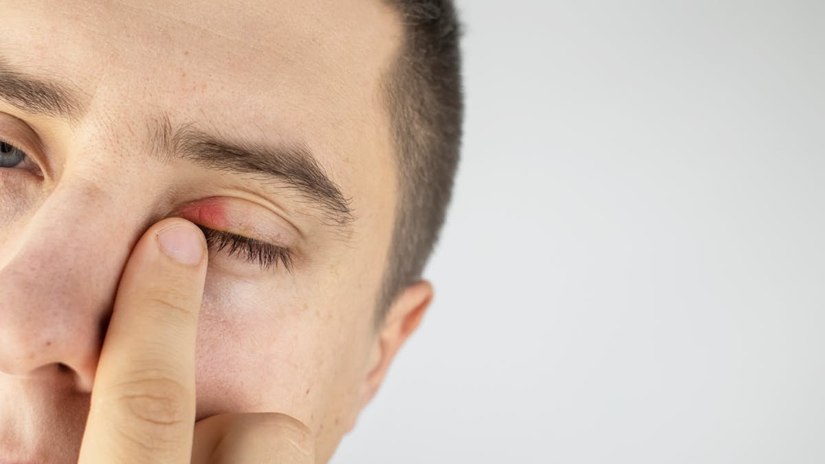 Blepharite Tout Sur L Inflammation Des Paupieres Et Des Cils Sante Magazine Blepharite Tout Sur L Inflammation Des Paupieres Et Des Cils Sante Magazine