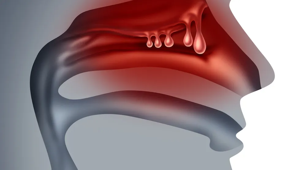 Polypose Polype nasal , polypose nasale : définition, causes, symptômes ...