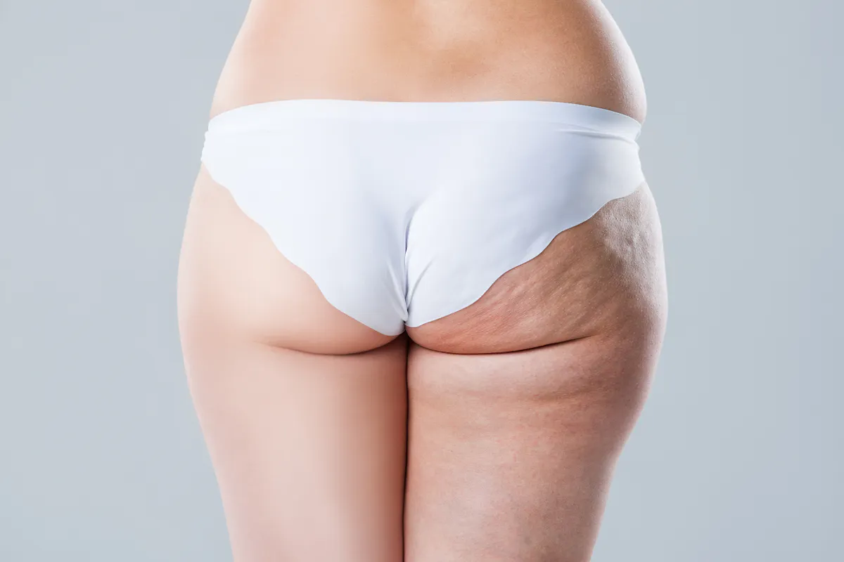 Cellulite : comment s'en débarrasser quand on a 30 ans ? | Santé ...