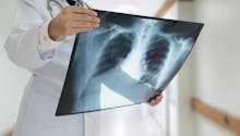 Cancer du poumon : bientôt un dépistage organisé chez les fumeurs ?
