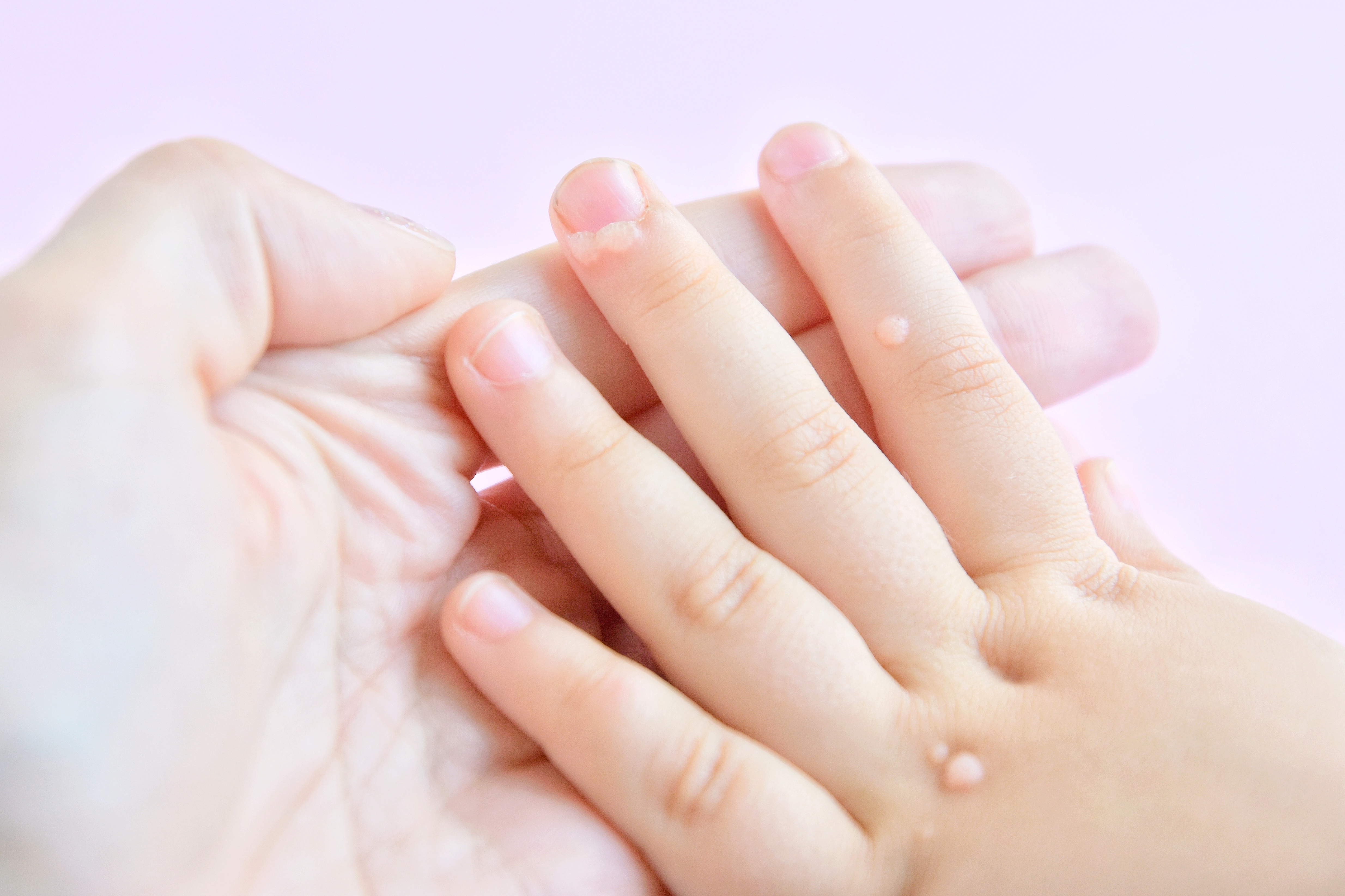 бородавка на пальце у ребенка фото