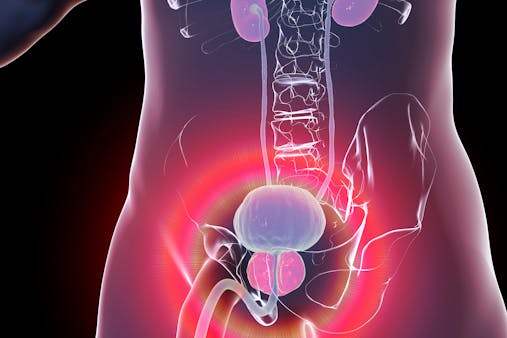 Adénome de la prostate : tout savoir sur l'hyperplasie bénigne de la prostate