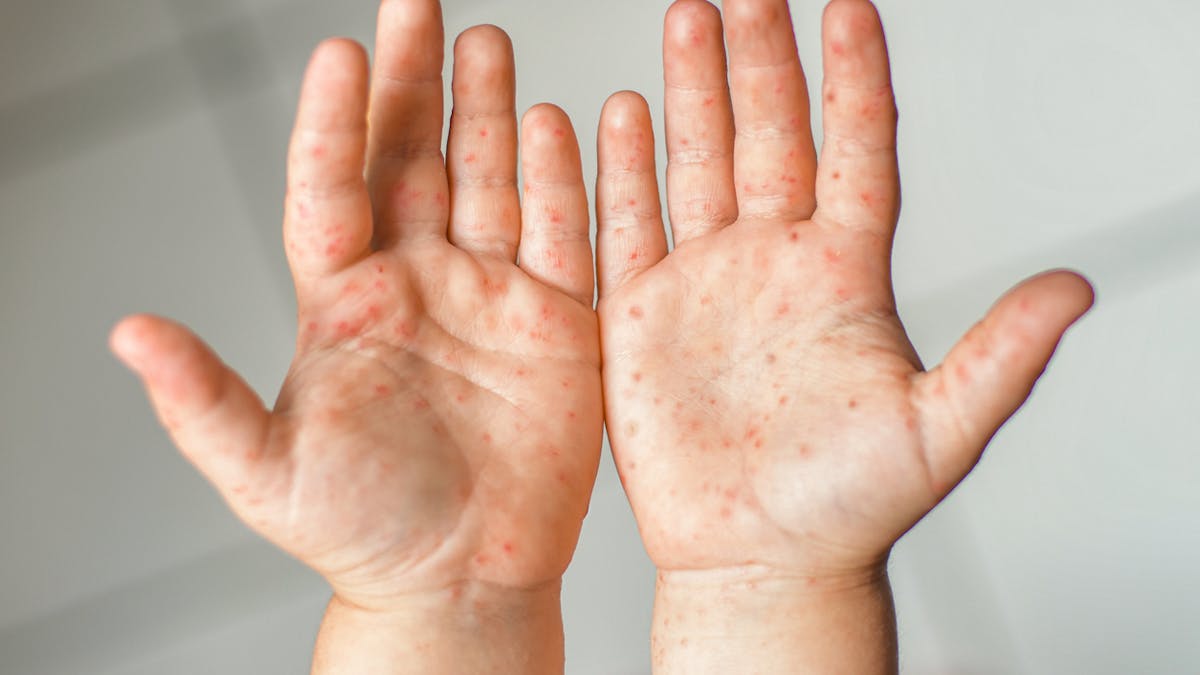 Éruption de la maladie pieds-mains-bouche sur les mains d'un enfant.