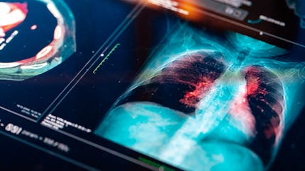 Cancer du poumon : bientôt un dépistage à partir d'un simple test sanguin ?  