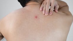 Abcès cutané : tout savoir sur cette infection purulente de la peau