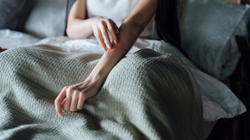 Atteinte d'une urticaire aquagénique, cette adolescente ne peut plus se