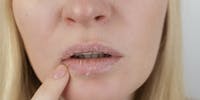 Eczéma de la bouche : comment le reconnaître et le soigner ?
