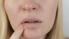 Eczéma de la bouche : comment le reconnaître et le soigner ?