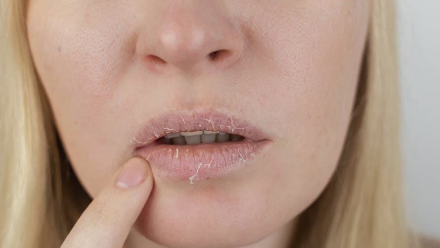 Eczéma de la bouche et des lèvres : causes et traitements | Santé ...