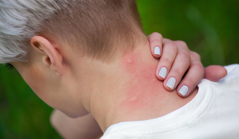 Comment savoir si on fait une allergie aux piqûres de moustique ?