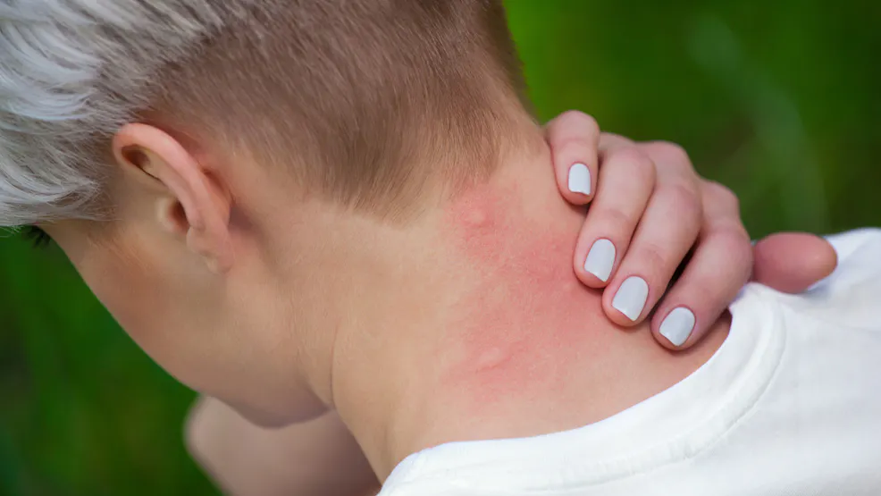 Allergie Aux Piq res De Moustique Comment La Reconna tre Sant allergie-aux-piq-res-de-moustique-comment-la-reconna-tre-sant