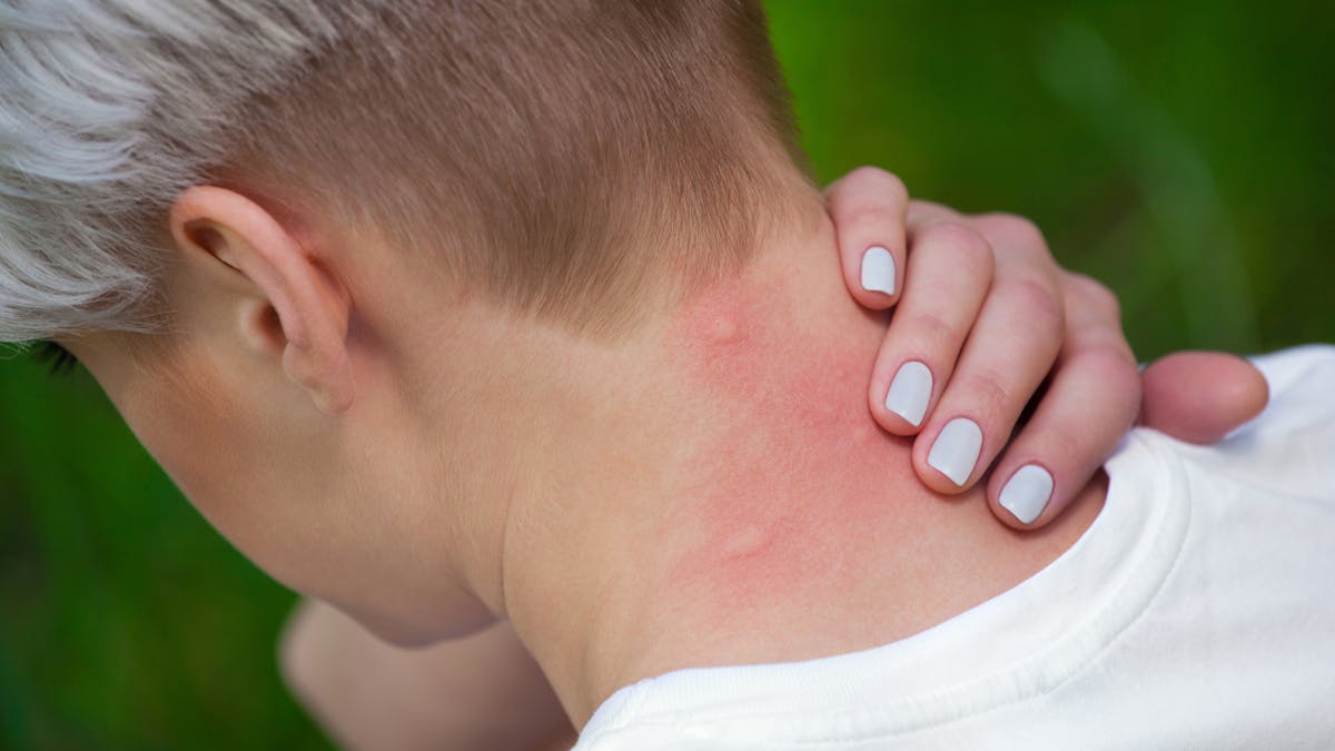 piqûre de moustique dans le cou avec réaction allergique