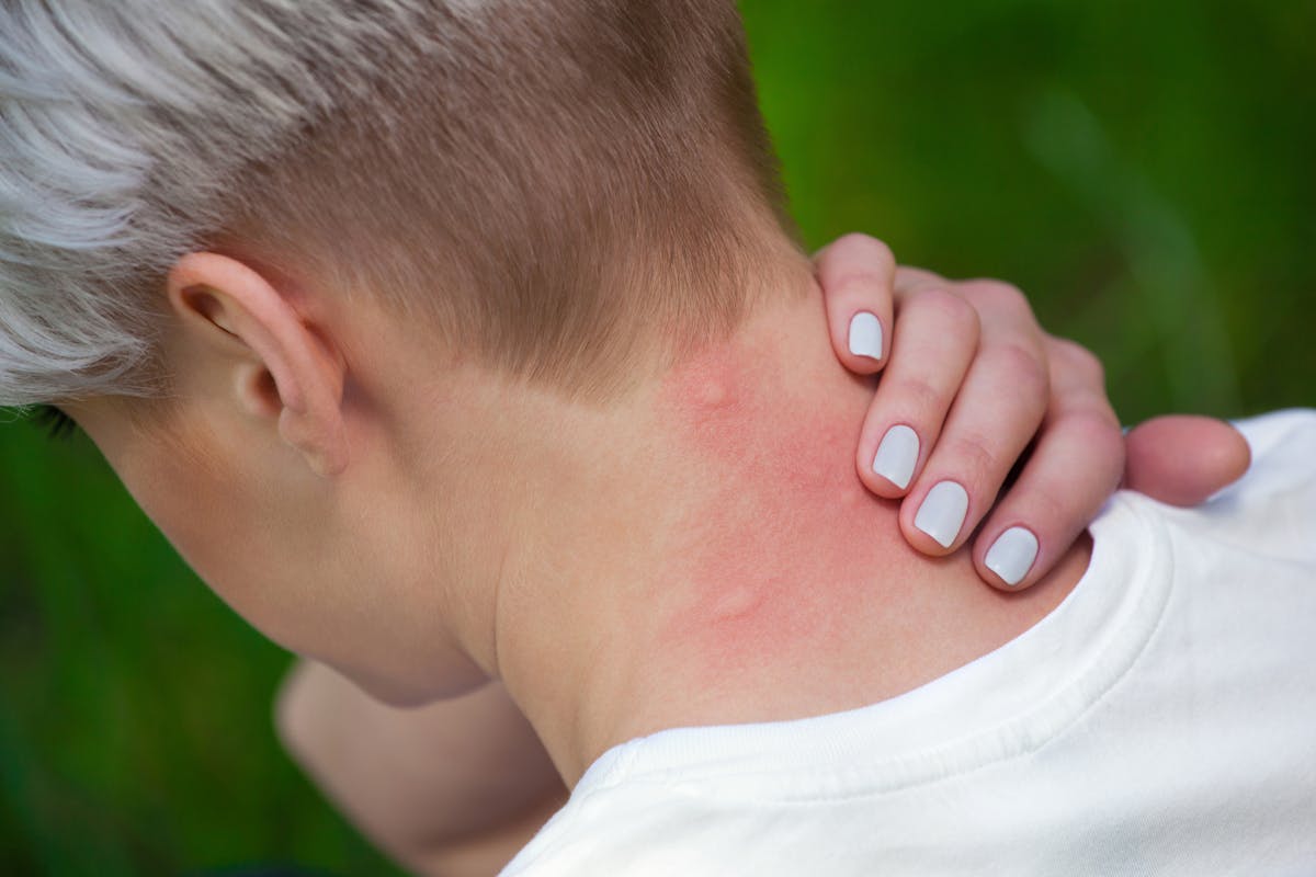 Allergie aux piqûres de moustique : comment la reconnaître ...