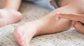 Piqûres de moustiques chez le bébé : comment gérer ?