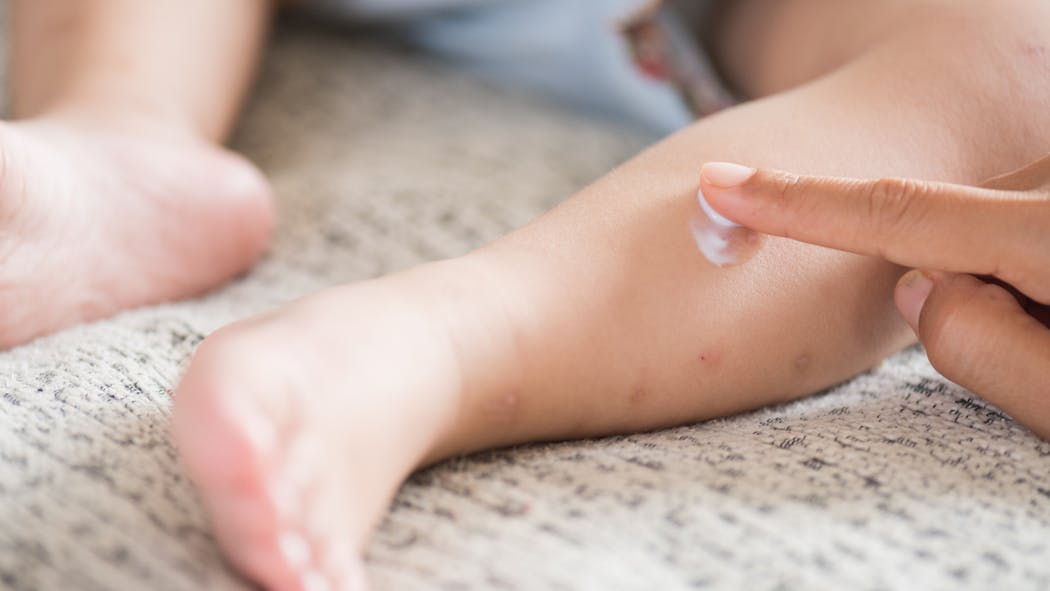 Piqûres de moustiques chez le bébé : comment gérer ?