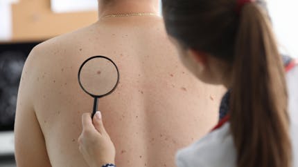 Cancer de la peau : cet aliment courant qui augmente le risque de mélanome