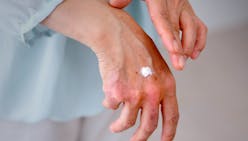 Engelure aux mains et aux pieds : causes et traitements