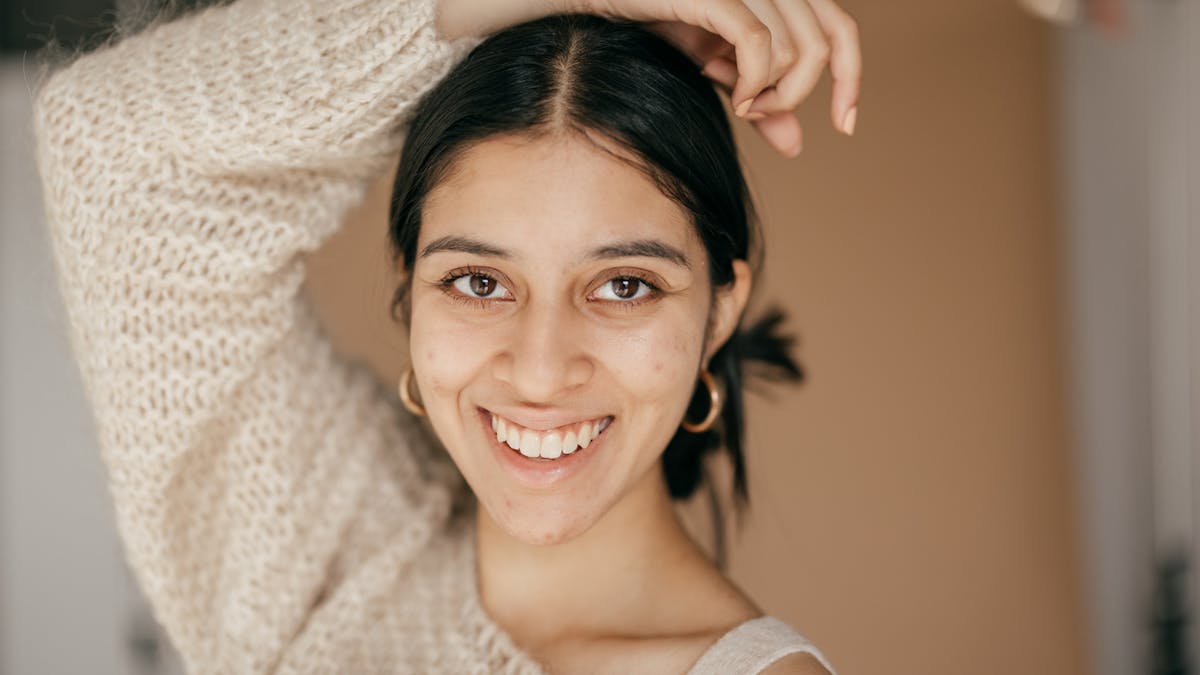 Une jeune femme souffre d'acné et garde le sourire