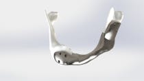 Première mondiale : une mâchoire en titane imprimée en 3D greffée avec succès