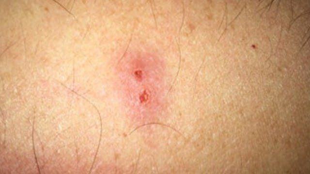 Piqûre d'araignée : comment la reconnaître ? que faire pour la soulager rapidement ? 3 Morsure d'araignée sur la jambe