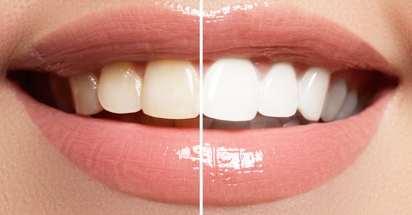 Quelles solutions efficaces pour blanchir les dents ?