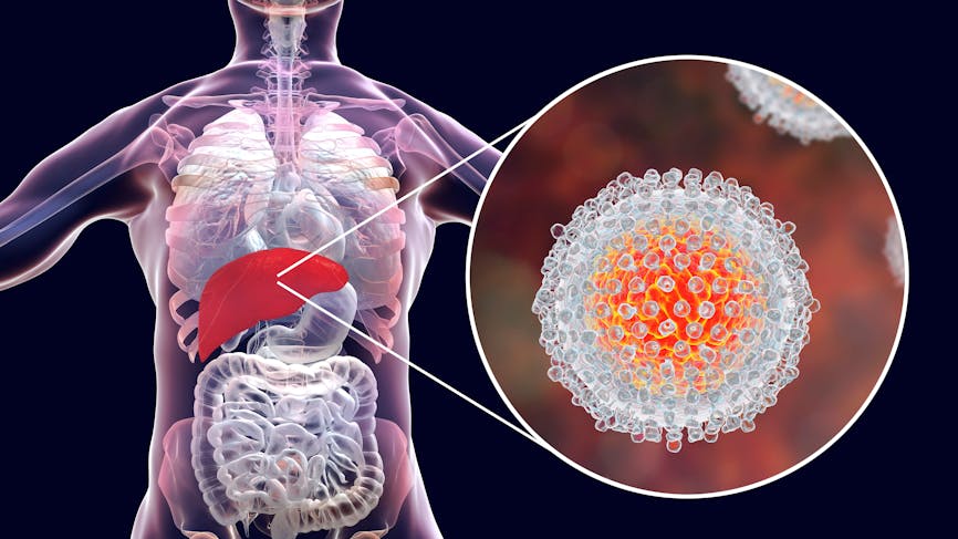virus de l'hépatite C infectant le foie  (illustration 3D)