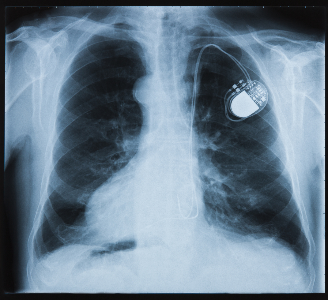 Défaillances de pacemakers Abbott : comment savoir si vous êtes ...