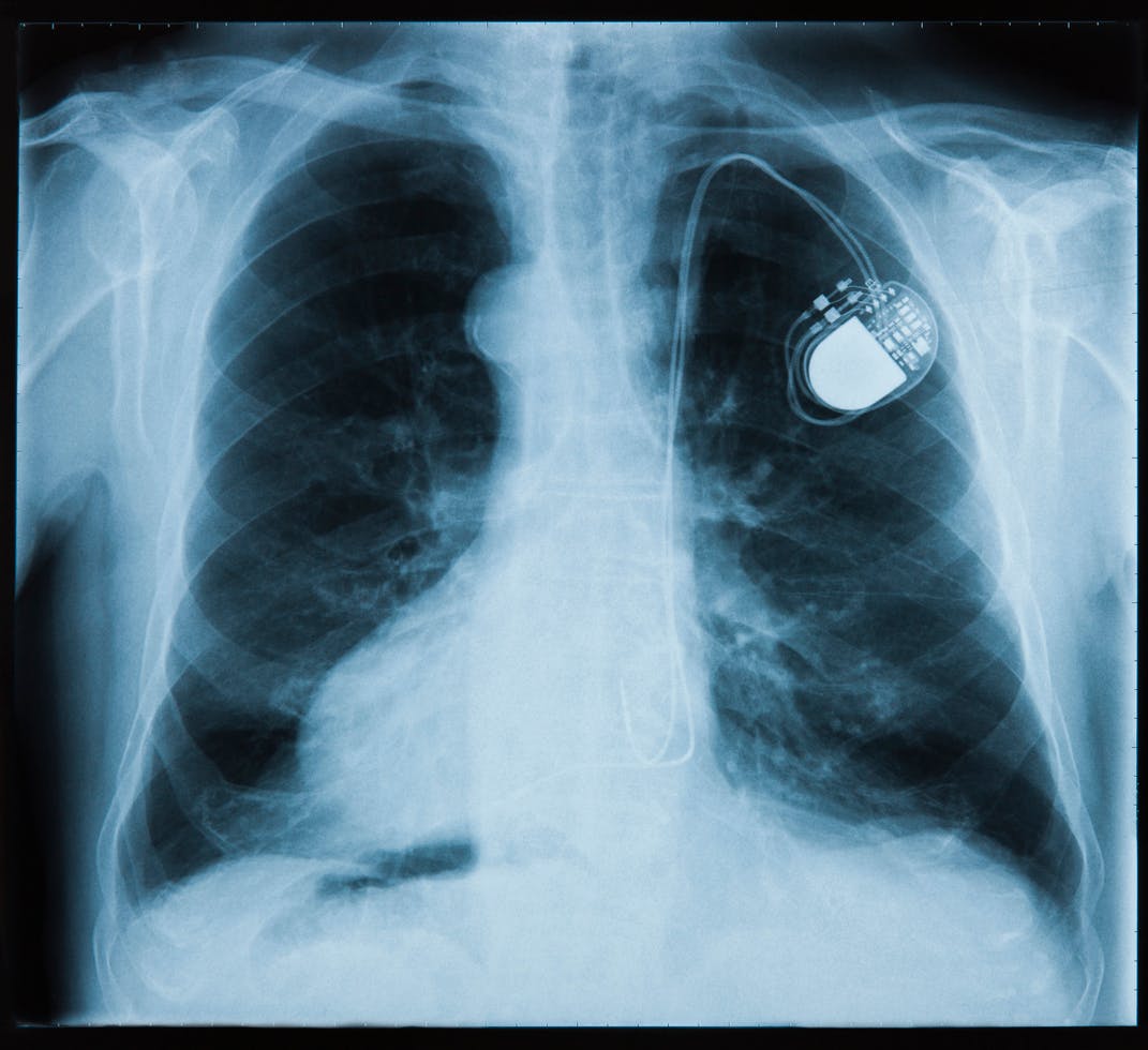 pacemaker defaillance que faire