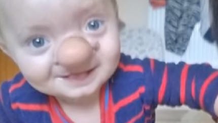 Un bébé naît avec un nez de Pinocchio, de quoi souffre-t-il ? 