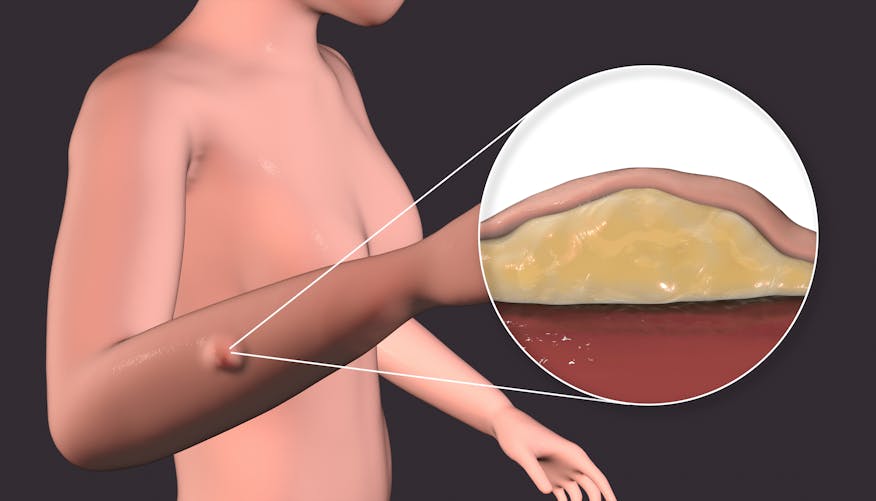 Boule de graisse sous la peau : comment l'enlever ?