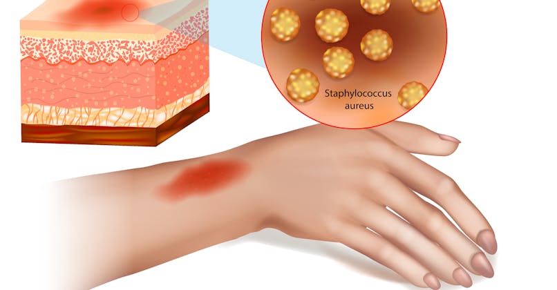 Infection de la peau par un staphylocoque, cellulite infectieuse