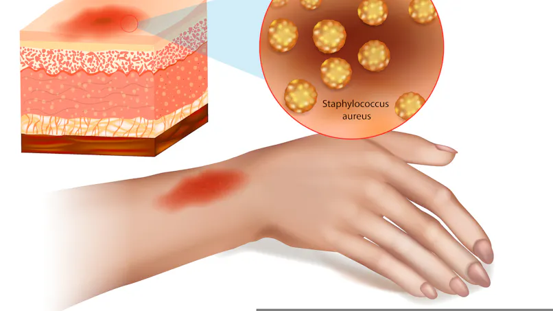 Cellulite Infected Cellulite infectieuse : causes, symptômes et traitements | Santé Magazine