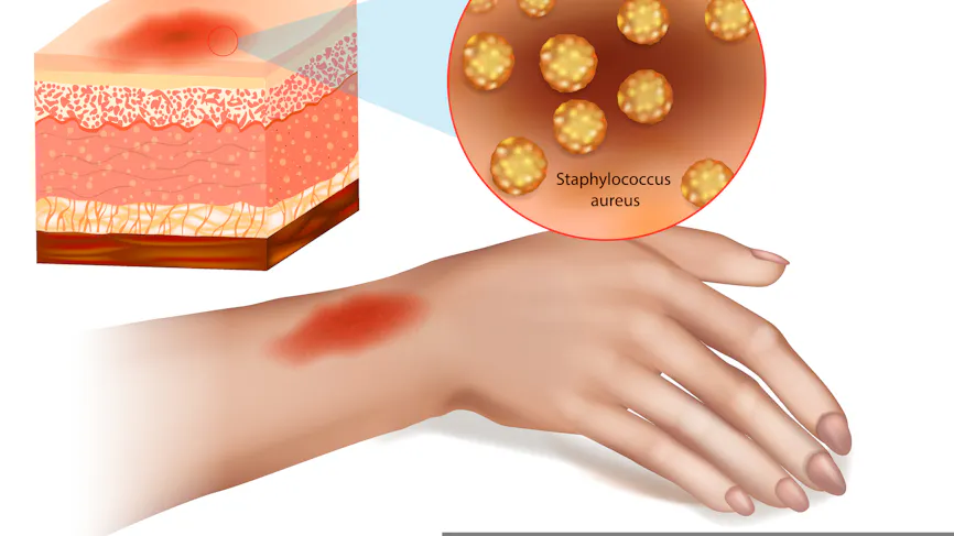 Cellulite Infectieuse Causes Sympt mes Et Traitements Sant Magazine cellulite-infectieuse-causes-sympt-mes-et-traitements-sant-magazine