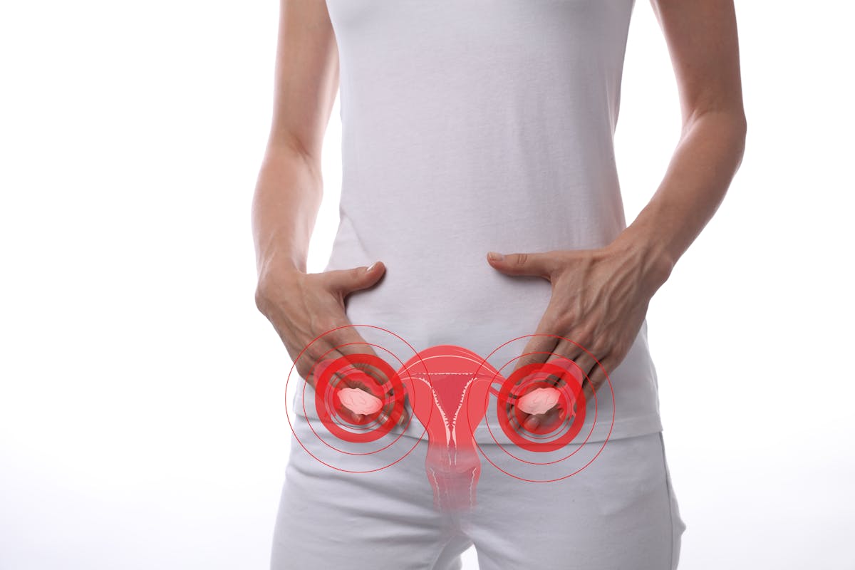 SOPK : symptômes et traitement des ovaires polykystiques