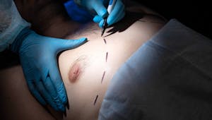 Qu'est-ce que la gynécomastie ? Pourquoi certains hommes ont-ils une poitrine plus développée ?