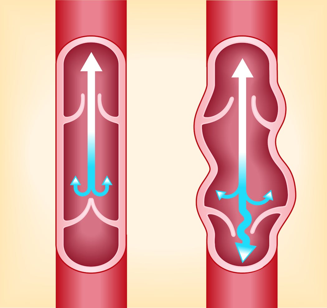 Varice : quand s'inquiéter ? comment la traiter ? | Santé Magazine