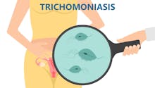 Trichomonase vaginalis : tout savoir sur cette IST très fréquente