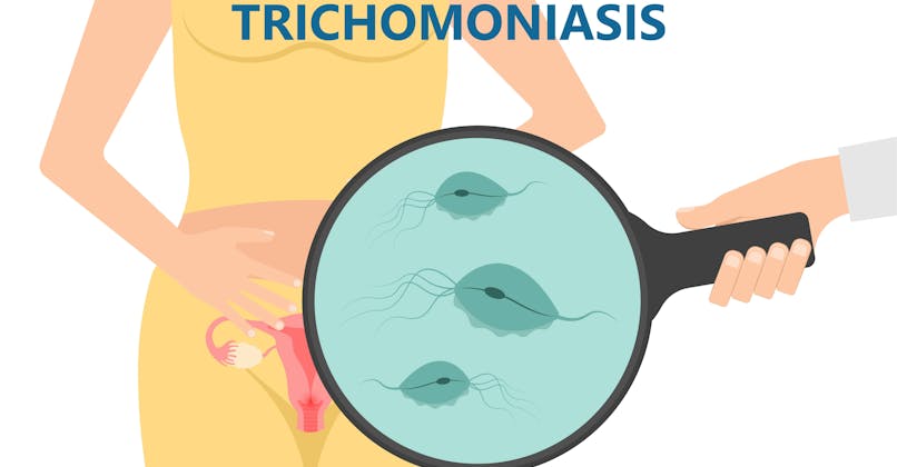 Infection à trichomonase, infection sexuellement transmissible