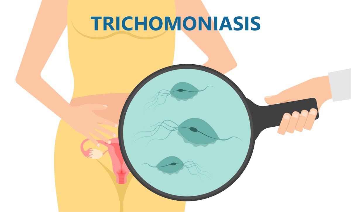Trichomonase : symptômes et traitements de cette IST très ...