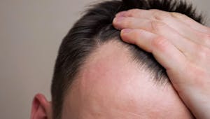 Calvitie : des experts révèlent l’implication d’une hormone qui provoque la perte de cheveux