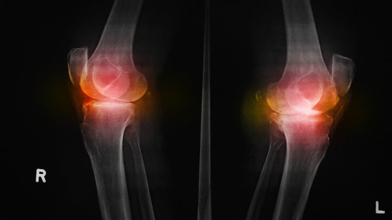 Ostéophyte, bec de perroquet  : excroisance osseuse articulation du genou