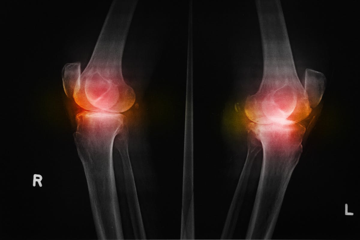 Ostéophyte, bec de perroquet : quelles causes ? quels traitements ...