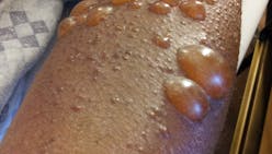 Pemphigoïde bulleuse : tout savoir sur cette maladie de peau de la personne âgée
