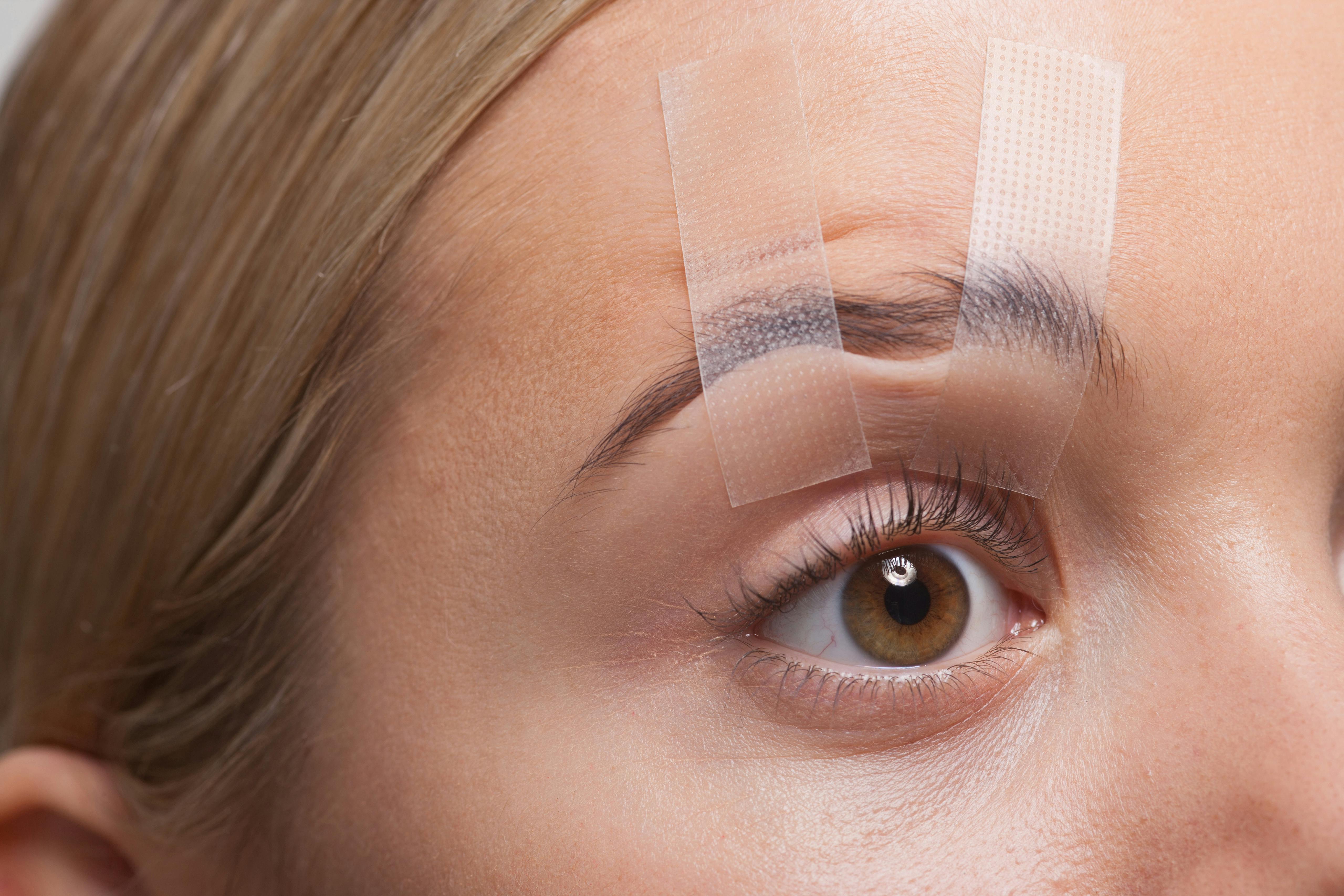 Eyelid. Пластырь при птозе верхнего века. Коррекция птоза верхнего века. Лифтинг глаз. Фотография патч для верхнего века.